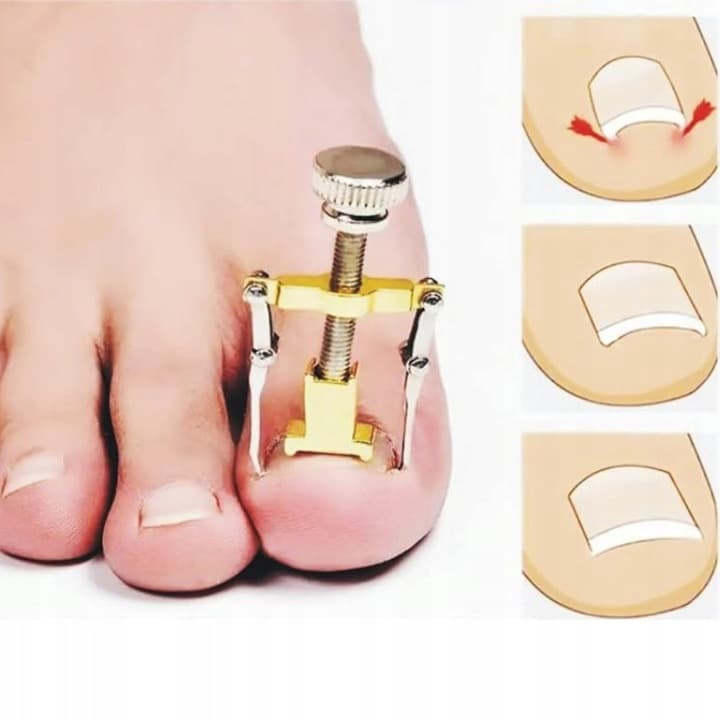 Klamra na wrastające paznokcie